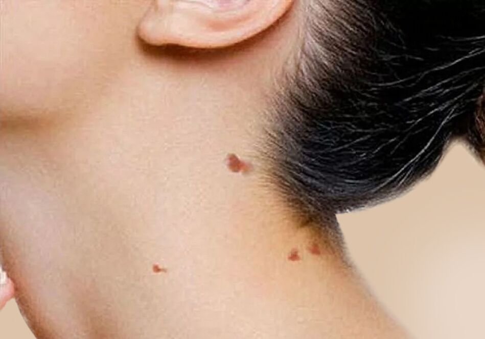 Das Auftreten von Papillomen am Hals nach Aktivierung von HPV im Körper