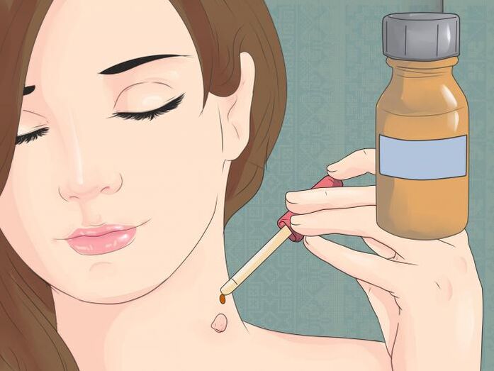 Verwenden Sie das Medikament in Form einer Lösung, um Papillom am Hals zu entfernen