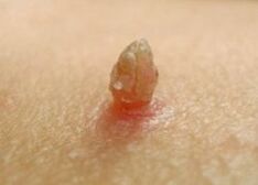 Scharfe Papilloma