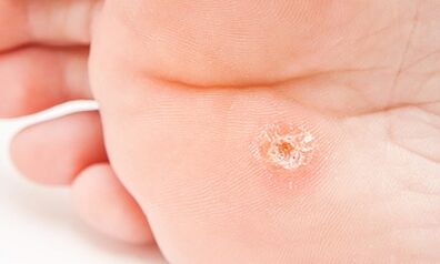 Warum erscheinen Plantarfärchen