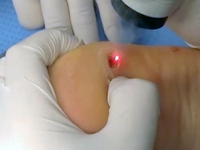 Laserbehandlung von Warzen