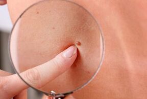 Gründe für das Auftreten von Papillomen am menschlichen Körper