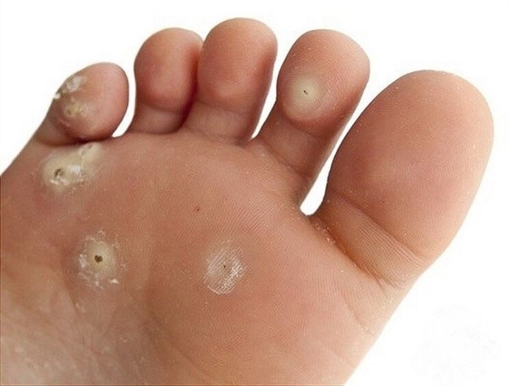 Plantarwarze